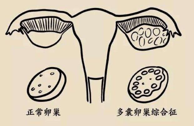 多囊卵巢综合征能生孩子吗？